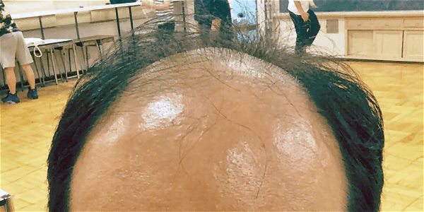 何歳でハゲたら若ハゲ？