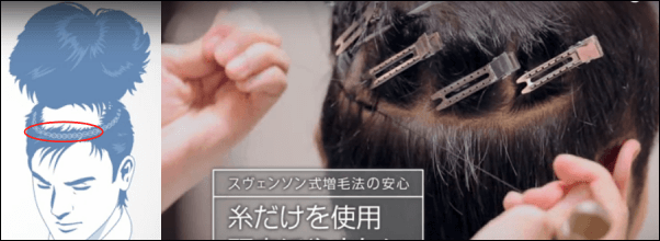 スヴェンソン式増毛法