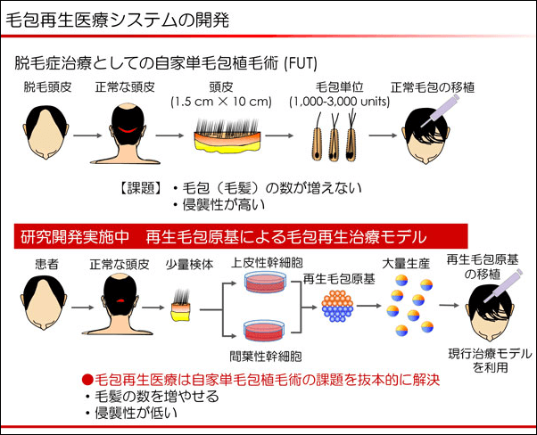京セラの毛髪再生医療