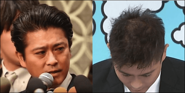 山口達也はハゲ？