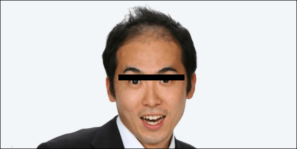 20代でハゲ