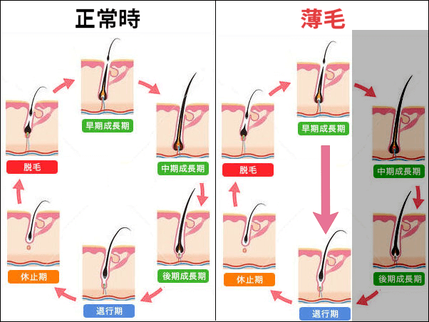 女性のヘアサイクルの乱れ