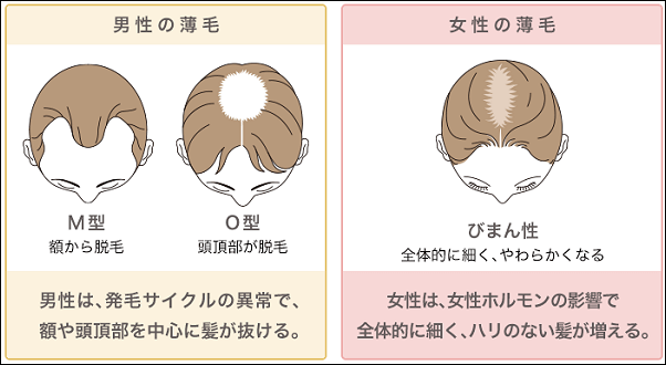 女性と男性の薄毛の違い